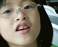 儿童牙齿畸形，预防是关键