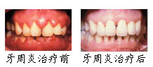 郑州唯美牙周炎案例