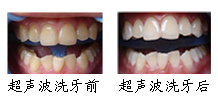 郑州唯美超声波洁牙案例