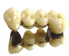 镶牙材料主要有哪些