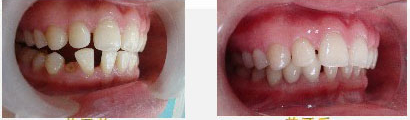 单颗牙齿缺失治疗前后对比