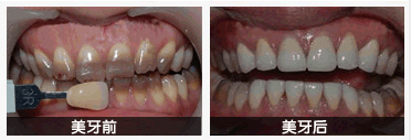 牙齿修复前后对比图