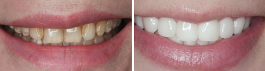 牙齿美容前后对比图