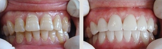 牙齿美容前后对比图