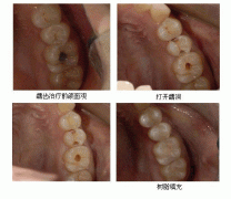 龋齿治疗方法