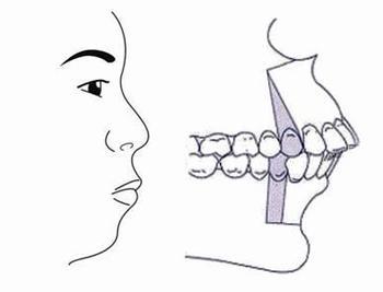 龅牙矫正后影响脸型吗