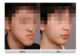 地包天矫正后需要注意什么 地包天矫正后需要注意什么