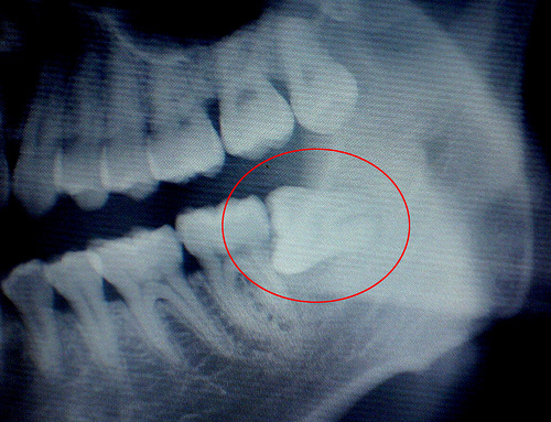 长智齿为什么会牙痛