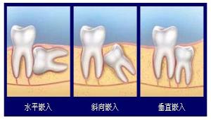 郑州治疗智齿哪家医院好