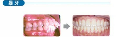 郑州龅牙矫正的费用是多少