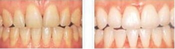 四环素牙是由什么原因引起的