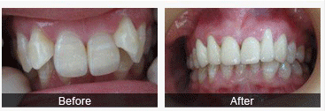 牙齿不齐会导致龋齿吗