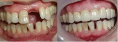 郑州门牙可以做种植牙修复吗