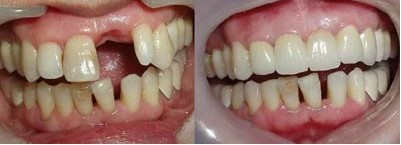门牙可以做种植牙修复吗