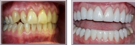 氟斑牙和四环素牙区别