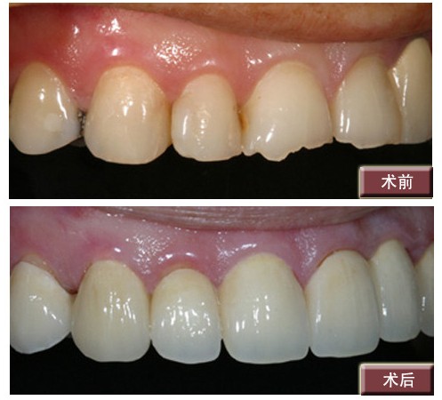 　3m纳米树脂补牙怎么样