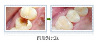 　补过的牙齿能用多久