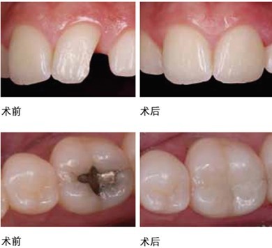 补牙大概贵不贵啊蛀牙