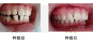 种一颗牙能呆多长时间