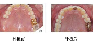 种植牙更佳时间是什么时候