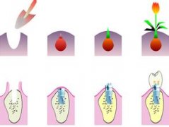 冬季种植牙恢复更快！