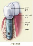 种植牙系统综述对比